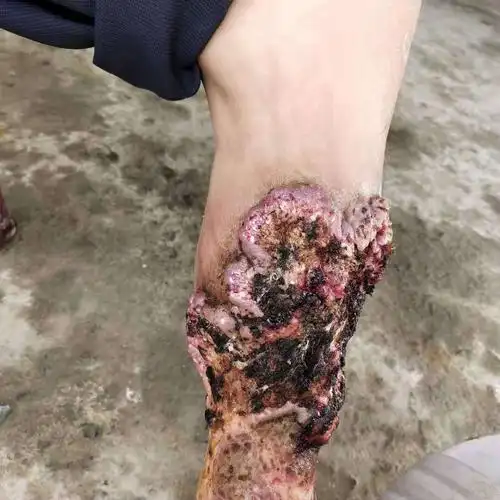 左小腿反复溃烂流脓2年