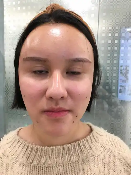 脂肪填充面部整形价格