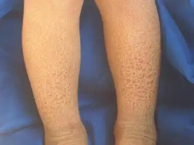 北京治疗鱼鳞病最好医院