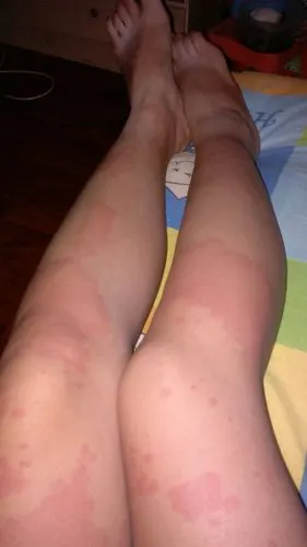 成整片的红疙瘩,红疙瘩处发热,与好皮肤界限明显.