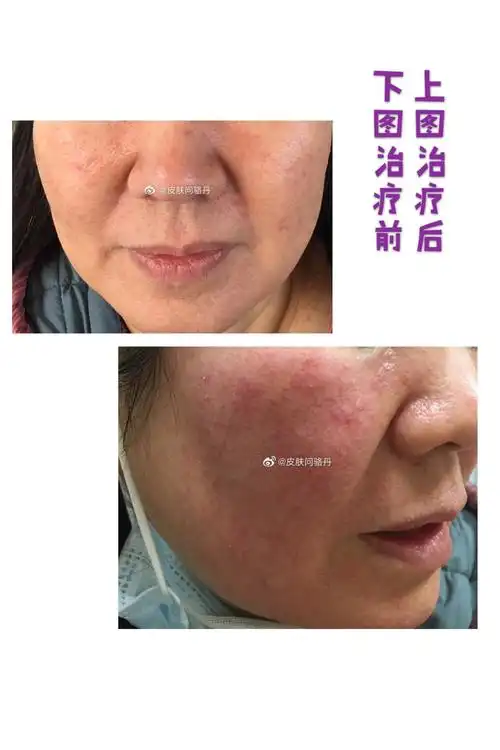 皮肤屏障受损 - 好大夫在线