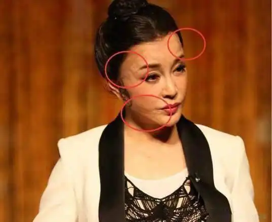 女星"整容"后遗症,关之琳脸变形,张檬像蜡像,她越来越像男人