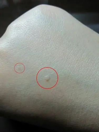 女性扁平疣图片