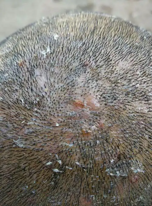 头皮病变!请诊断