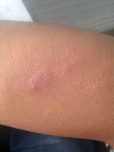 手臂上有很多鸡皮疙瘩 并且是一块一块的 请问这是什么病