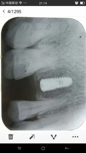 青年牙医胡医生种植牙病例分享