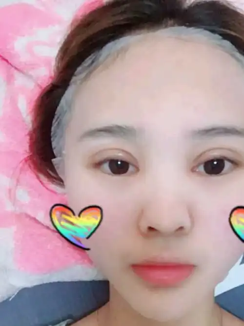 美女做个双眼皮,前期恢复有点恐怖,但50天后,效果有点