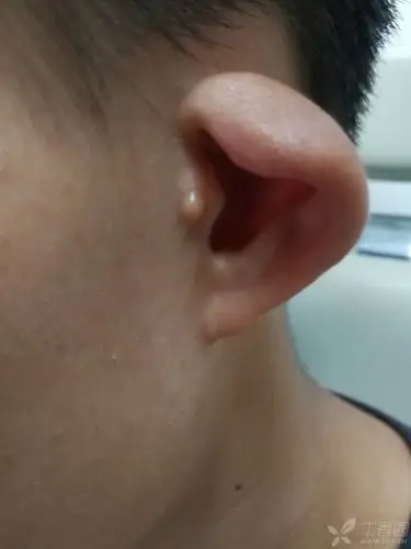 大小不对称 体格检查:双耳杯状耳,左耳廓较右耳廓大,但耳轮脚至耳垂