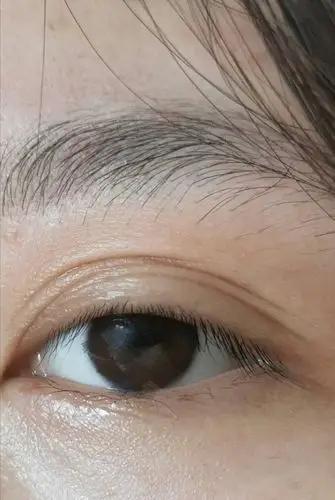 眼皮忽然多了一层