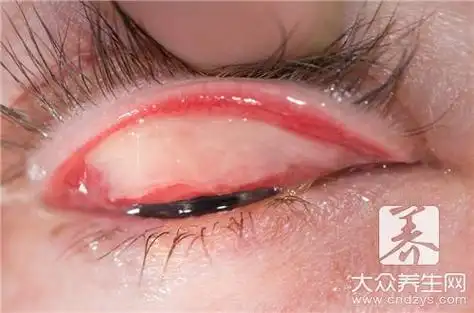 先去看看什么是结膜炎吧,结膜炎其实就是一种覆盖在人们的眼睑内面,且