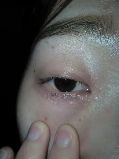 眼周围长了很多小米粒,灯光一照就很明显,一个月多长了很多,而且慢慢