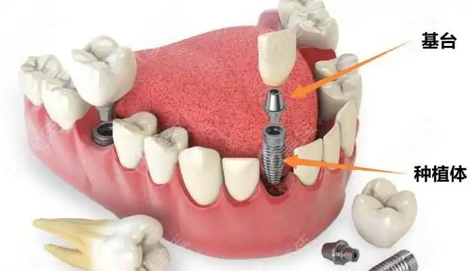 一段式种植牙有哪些请问一段式种植和两段式种植有什么区别选谁好