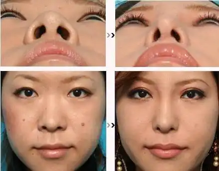 jw鼻翼缩小手术适应哪些人群?