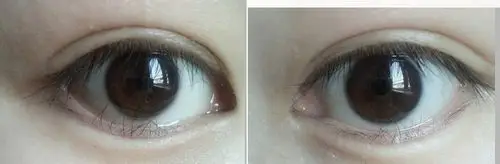 这样算下眼睑内翻吗?睫毛扎在里面很难受,有什么好的办法?