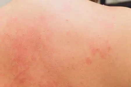 疾病的过敏性瘙痒, 皮疹, 保健和医学概念小孩子有素质症状的脸颊特写