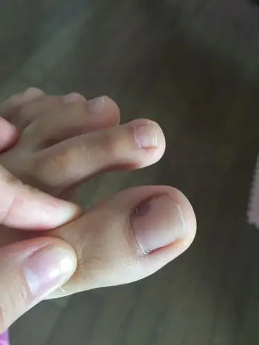 早晨起床发现脚趾大拇指这样 是怎么回事?