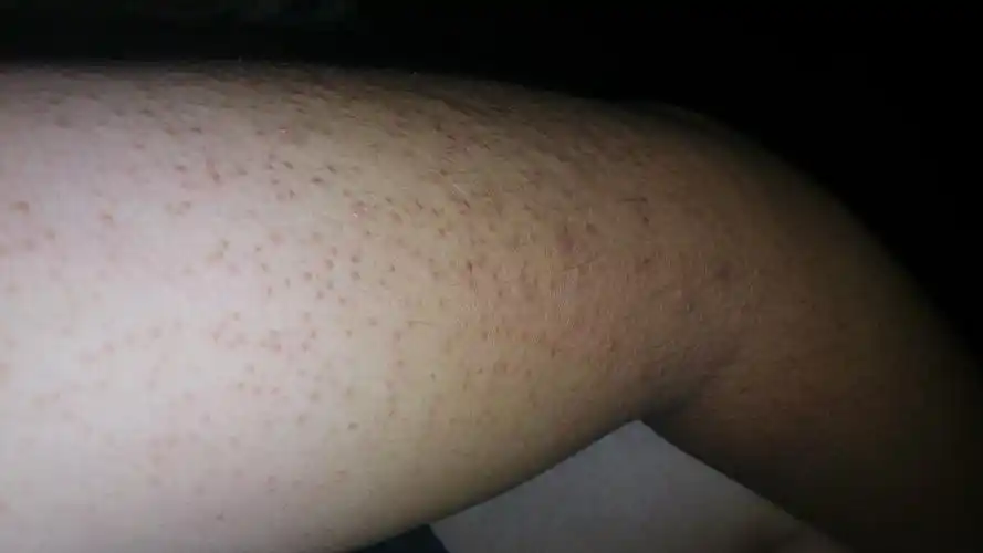 不疼不痒,遇冷风偶尔会痒,一抓会发红,看着很严重,好像毛孔堵塞,我这