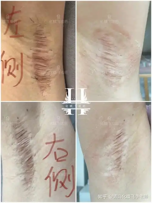 十几年的腋下手术疤痕十几天的修复效果对比
