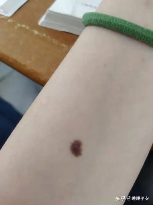 身边不少人手腕或手臂中央都有一颗痣不知道是概率事件还是什么玄学你