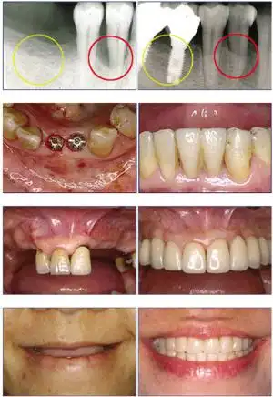 种植牙前后对比图.
