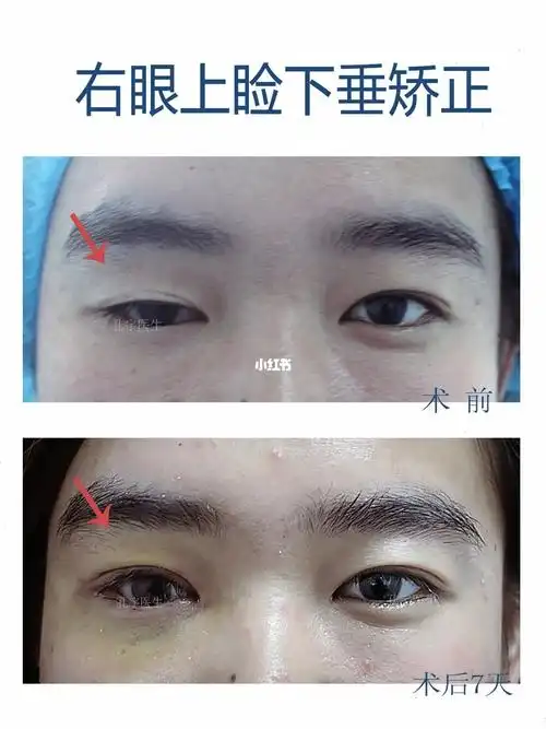 右眼上睑下垂矫正