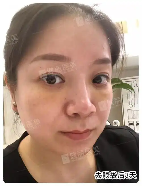 怎样去泪沟才彻底?