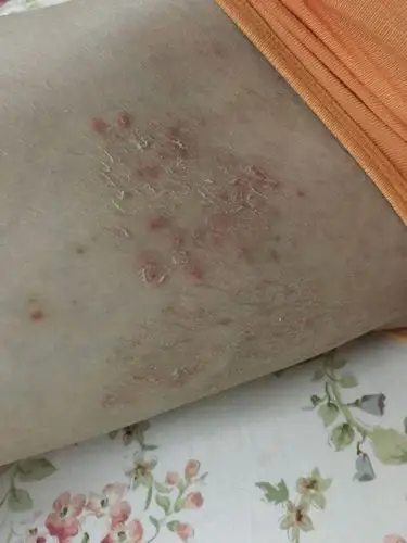 大腿两侧检查,真菌菌丝引起的色素细胞增多,不怎么痒,但是感觉患处