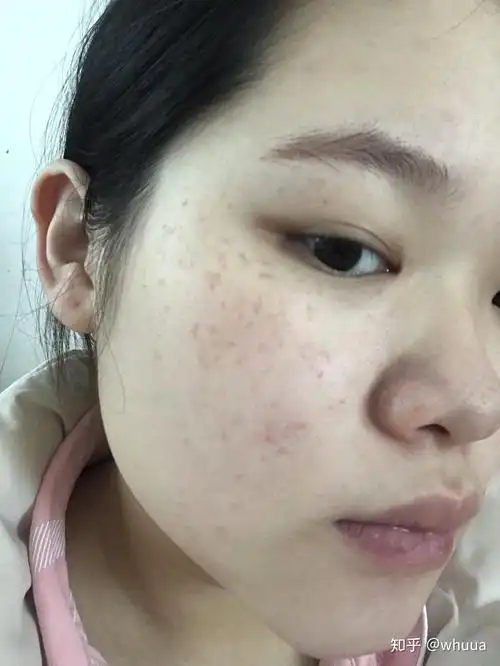 致长斑的姐们一点念想