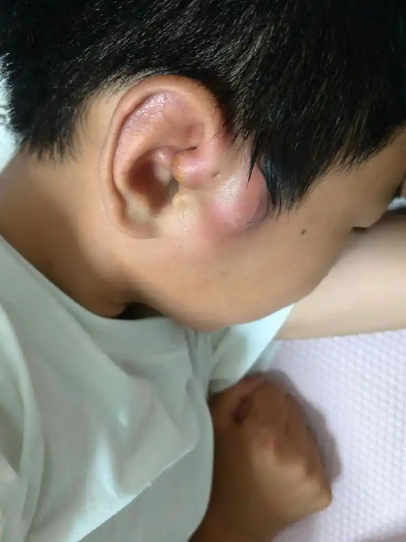 万能抖音平台,可有知道耳朵上有个小洞,一有炎症就肿起来,一次 - 抖音