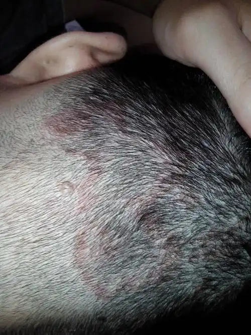 脑袋后面长了好多这样的红斑,我今天理完发才发现的,有一段时间了,有