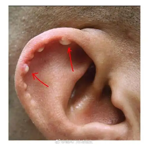 耳廓边缘的痛风石
