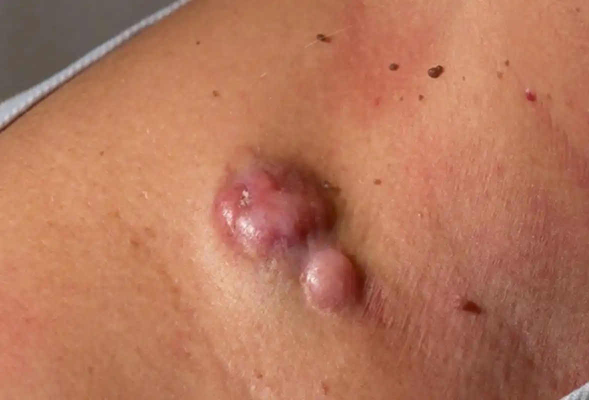 纤维肉瘤是一种恶性软组织肿瘤,源于间叶结缔组织,主要由增生的犀维