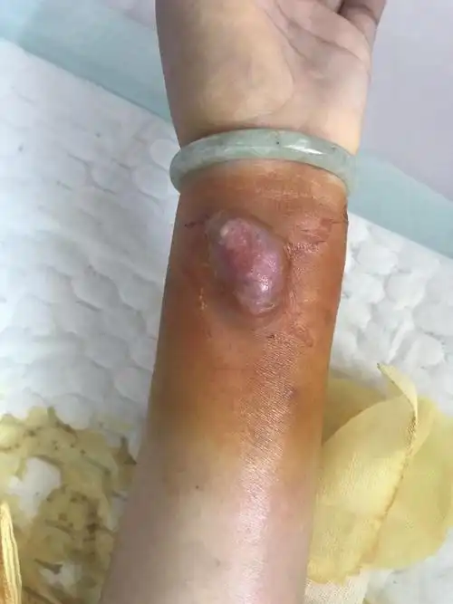 留置针针眼感染