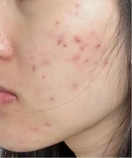 本人油痘肌急需改善皮肤!不想再做油腻邋遢女生了! - 知乎