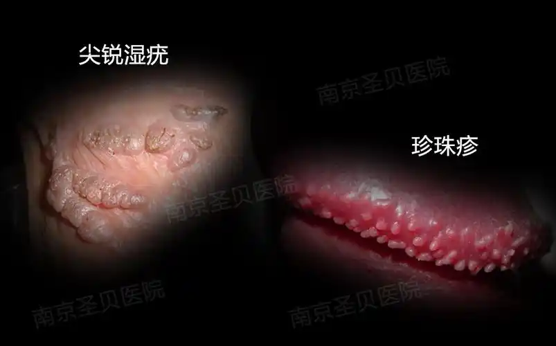 尖疣和珍珠疹对比照片