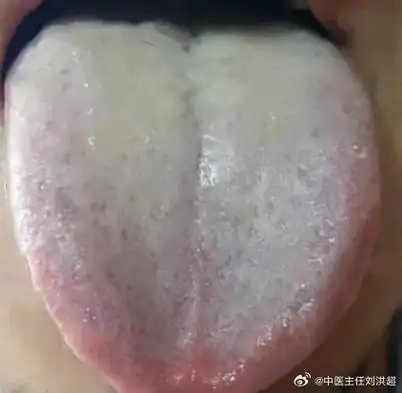 中医##国医的精诚力量##中医舌诊