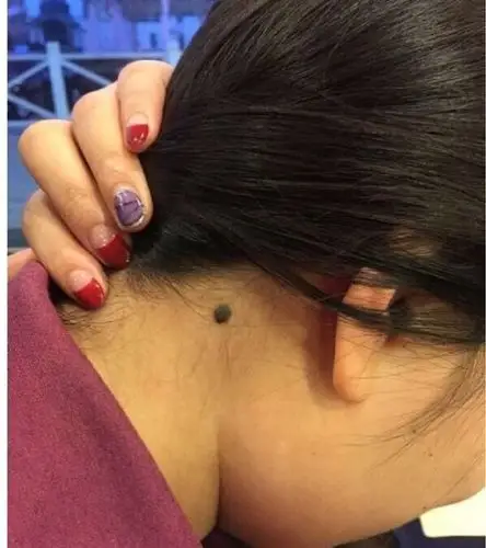 脖子后面有黑痣的人尽量少熬夜