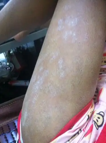 问:全身大面积,不痒不疼,但是感觉像癣.怎么回事?如何治疗