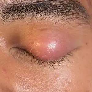 眼睛盖子脓肿麦粒肿照片
