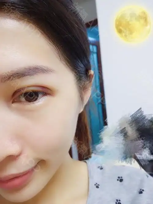 埋线双眼皮第二天,麻药过了居然才一点点痛感,我还以为会