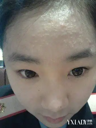 如何治疗面部轻微毛囊炎呢面部毛囊炎的治疗方法大全