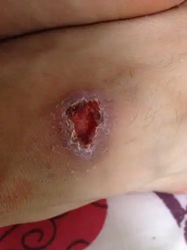 问:伤口结把.我刚刚看它像跟皮长一起了一样就扣掉了.现在该怎么办.