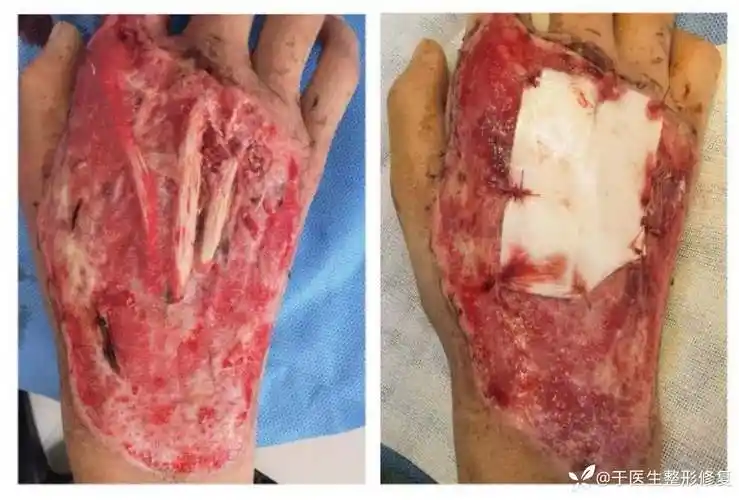 自制双层人工真皮修复热压伤后肌腱外露创面
