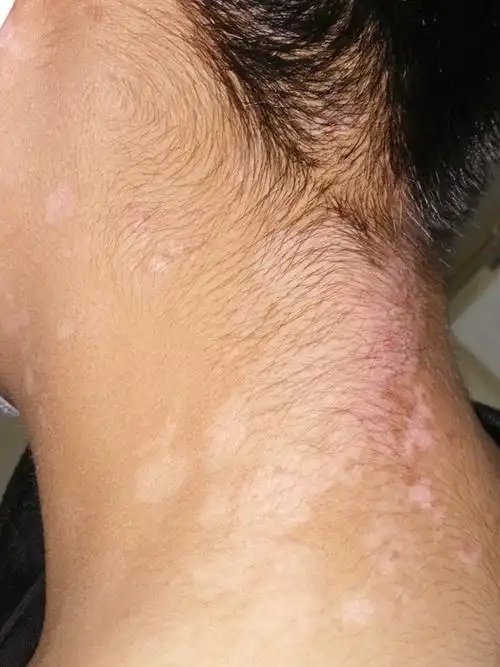 15岁男生患白癜风,需要早发现,早治疗