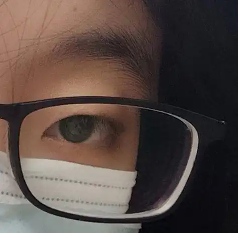 高度近视后眼睛很丑