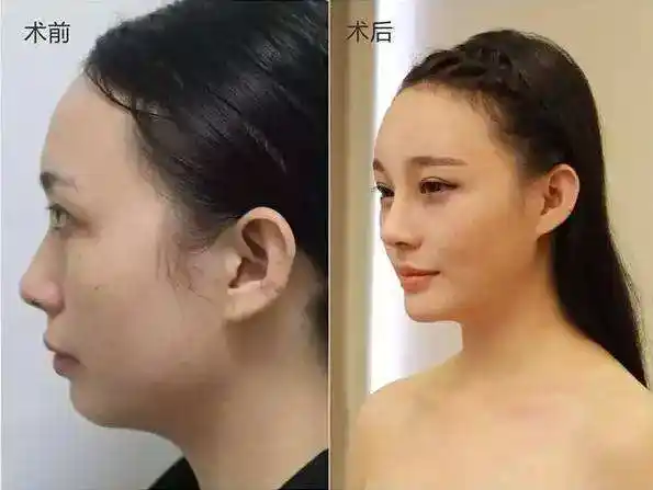 不对比就没有伤害,比起天然的低鼻梁,我更喜欢隆鼻一直普通的你会在