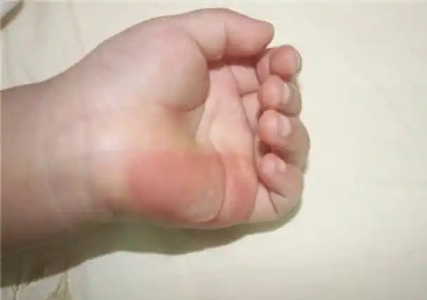 宝秀兰儿童发展中心 的想法: 孩子被烫伤后应该如何正确处理呢?