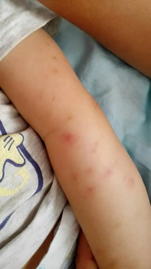 推荐回答 我分析宝宝这应该是季节性的丘疹性荨麻疹的症状,由于过敏
