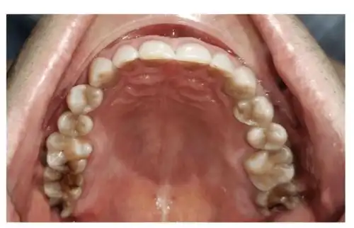 【病例】上颌第二恒磨牙大面积磨耗emax瓷嵌体微创修复