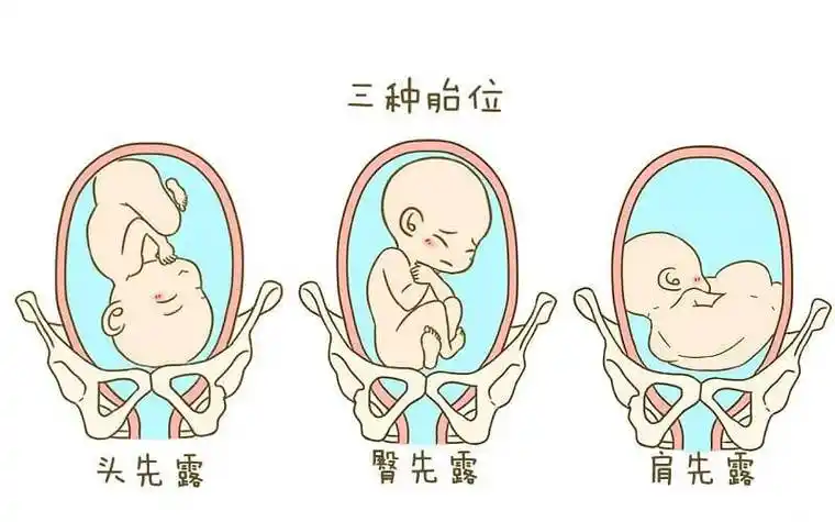 详解胎儿横位是什么意思附高清姿势图